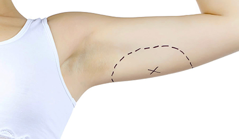 Experts in sculpting sections of the body including Chin, Neck & Arms